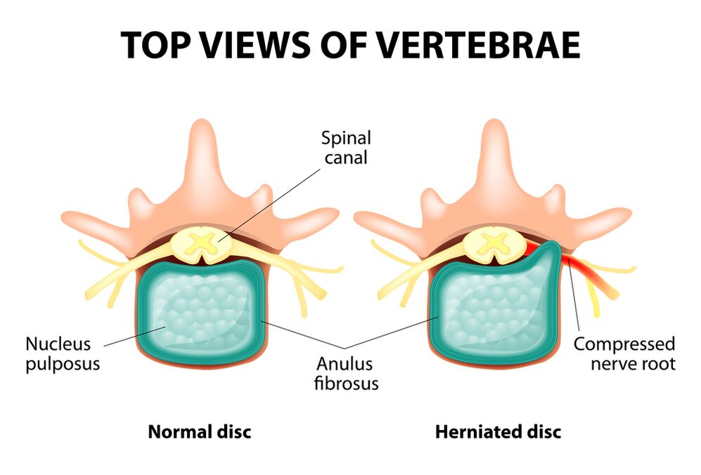 Disc intervertebral sănătos și hernie