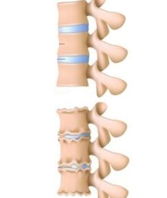 Cauzele osteochondrozei