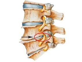 Semne și simptome ale osteochondrozei