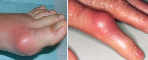 apariția articulațiilor cu artrită