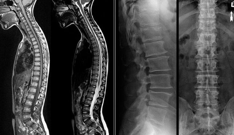 Imagini cu raze X și RMN pentru osteocondroză