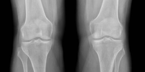 radiografie osteoartrita genunchiului