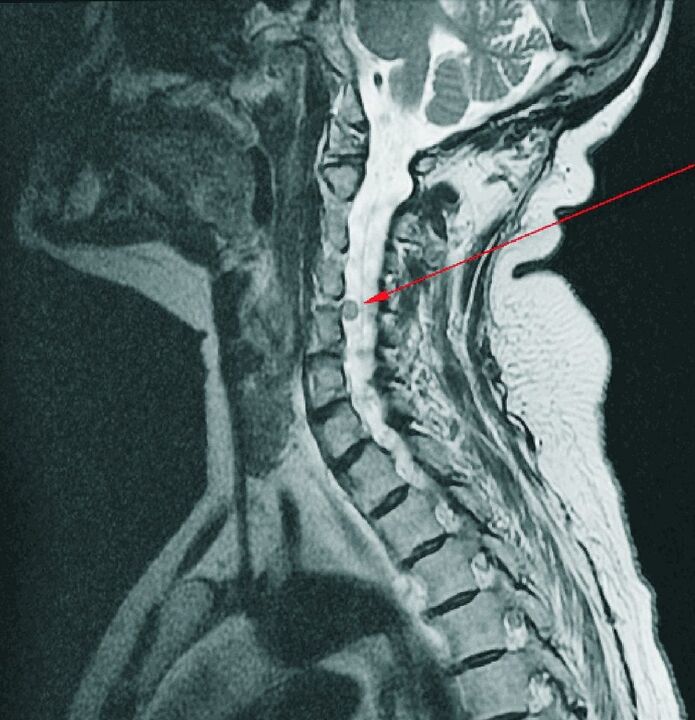 Hernia intervertebrală a coloanei cervicale la RMN