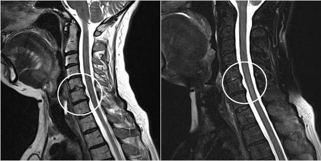 RMN al coloanei cervicale cu semne de osteocondroză