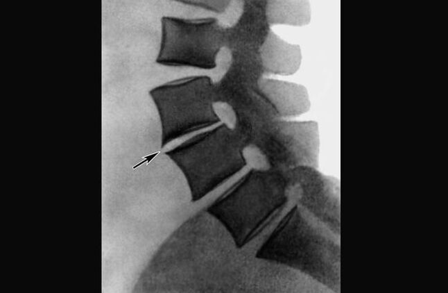 Manifestări ale osteocondrozei coloanei vertebrale toracice pe radiografie