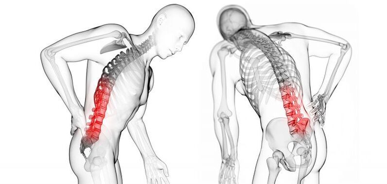 complicații cu osteocondroza cervicală